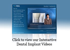 Los implantes dentales Presentación