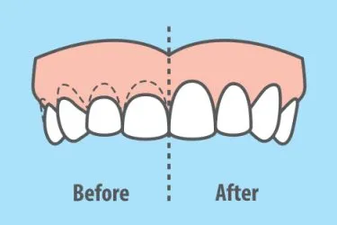 before and after Gingivectomy illustration