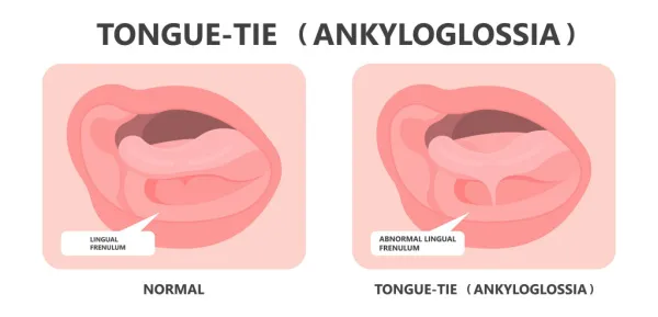 Frenectomy illustration