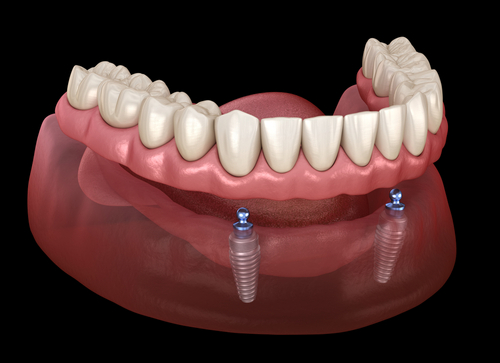Sobredentadura de dos implantes