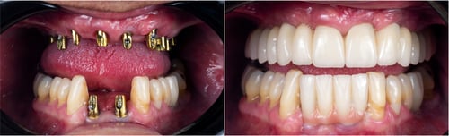 Los implantes individuales superiores