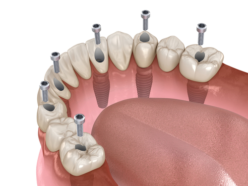 Hybrid or Screw Retained Denture 3D model