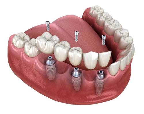 Plantation Individual Dental Implants 3D Model